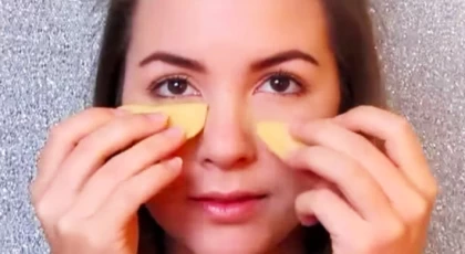 Göz altı morluklarını ortadan kaldırın. Patates göz altı morluklarına iyi gelir mi?