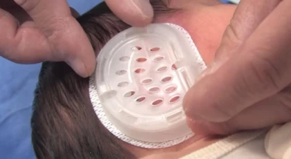 Bebeklerde ameliyatsız kepçe kulak tedavisi